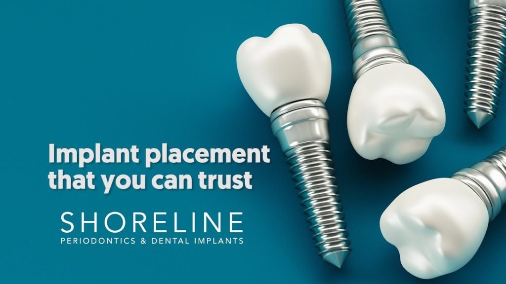 Trusted Dental Implant Parts Suppliers Near You | Get Quality