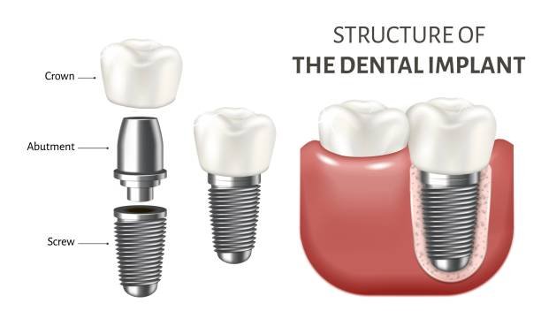 Trusted Dental Implant Parts Suppliers Near You | Get Quality