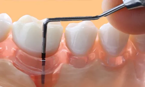 A Vital Instrument for Gum Health the Periodontal Pocket Marker
