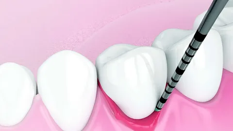 A Vital Instrument for Gum Health the Periodontal Pocket Marker